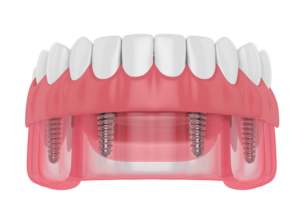 诺贝尔种植牙 诺贝尔种植牙